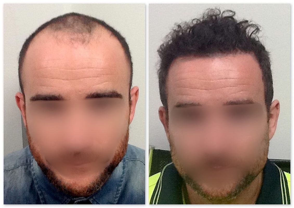 New-Hair-Clinic-Hair-Transplant-PM-AB