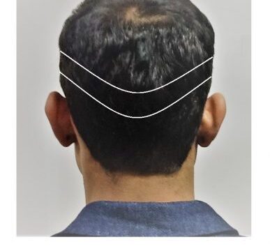Look-After-Your-Precious-Donor-Follicles-new-hair-clinic-sydney.jpg