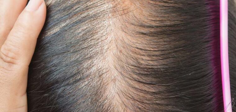 New Hair Clinic Noticing the Signs of Hair Loss