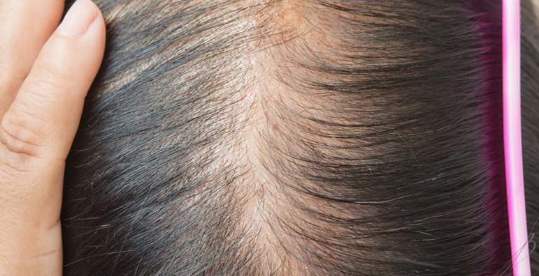 New Hair Clinic Noticing the Signs of Hair Loss