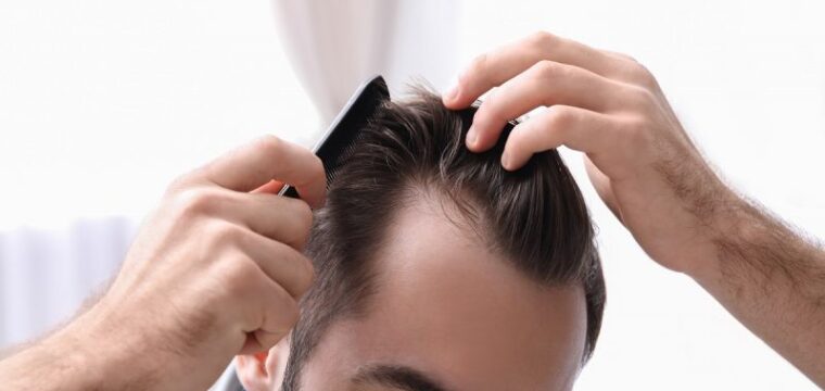 Detecting the Signs of Hair Loss