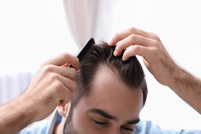 Detecting the Signs of Hair Loss