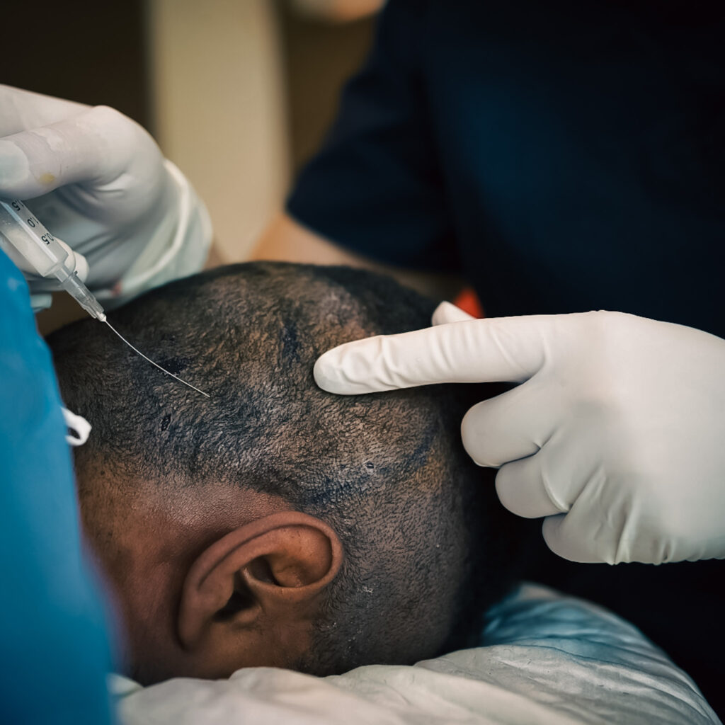 Hair Transplant; how to ensure the best results. Hair Transplant; how