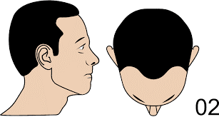 m shaped hairline due to receding hairlines