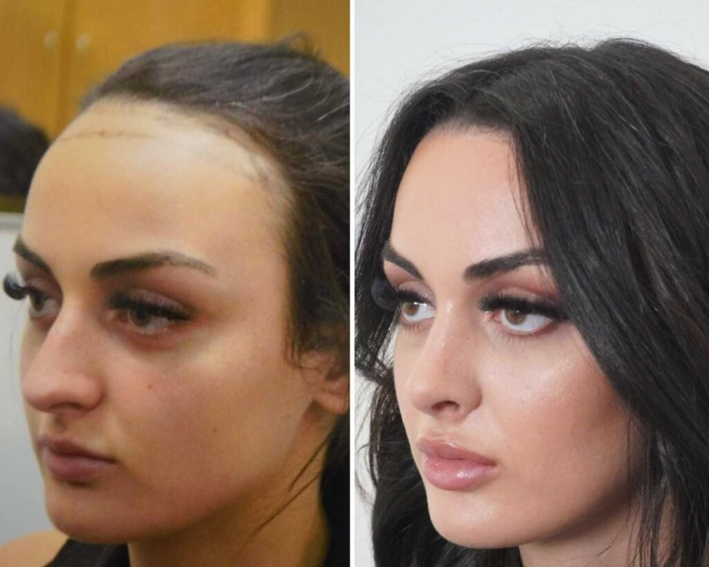 Hair Loss Treatment Perth Hair Restoration