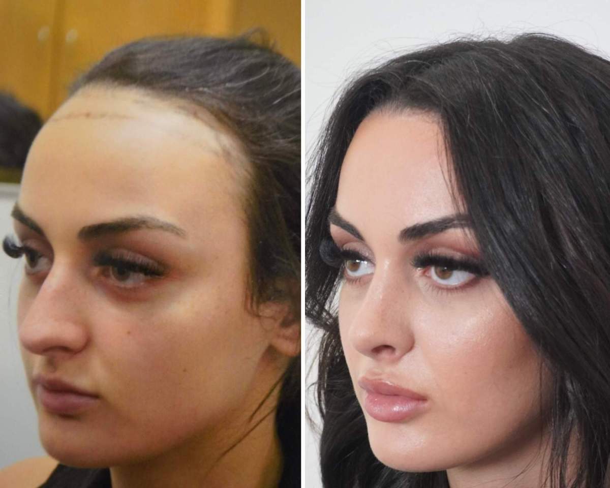 scalp blood supply from hairline recession