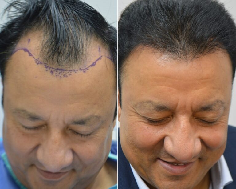 Hair Loss Treatment Perth Hair Restoration