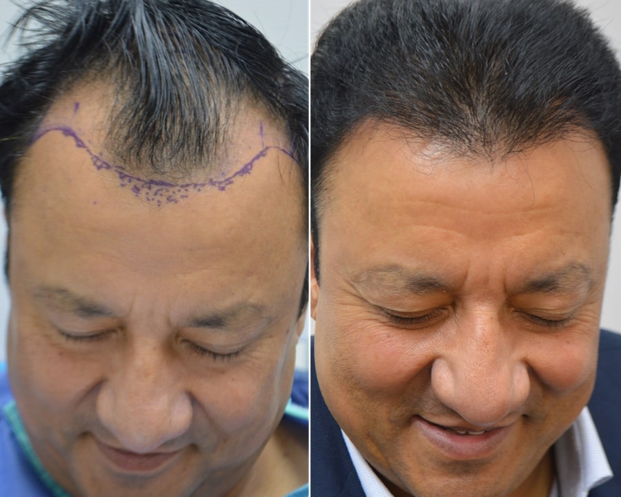 follicular unit extraction fue hair bearing skin