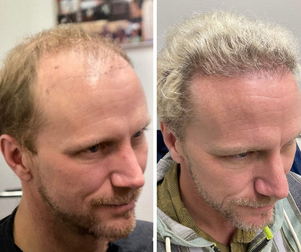 blond hair transplant before and after