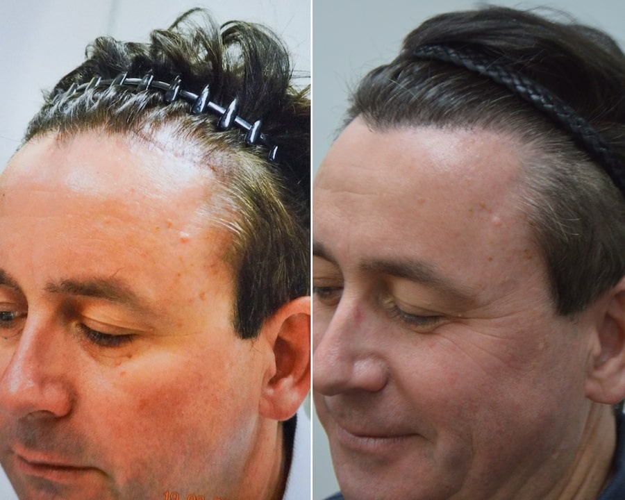 can you have a hair transplant over a scar