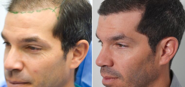 Hair Transplant Results