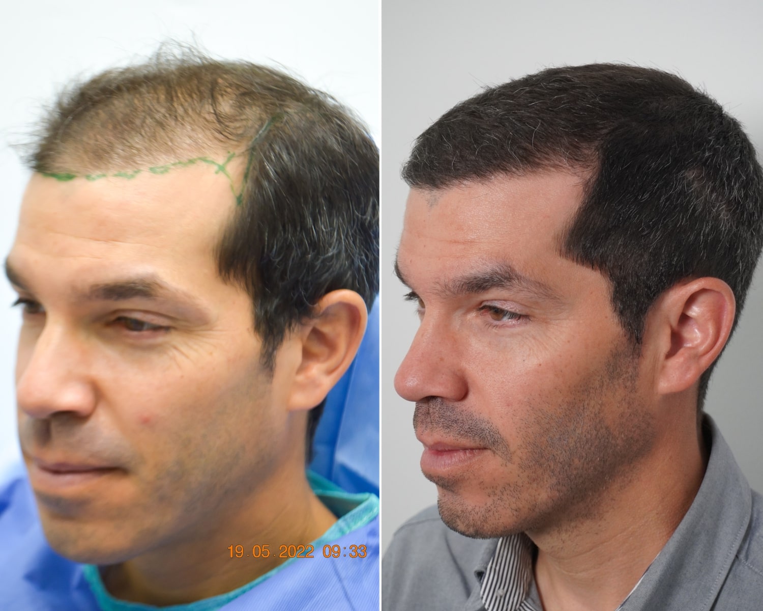 FUT hair transplant before and after