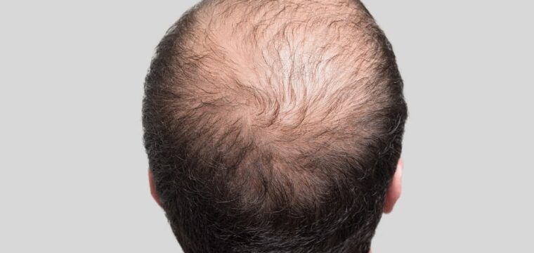 Balding Crown