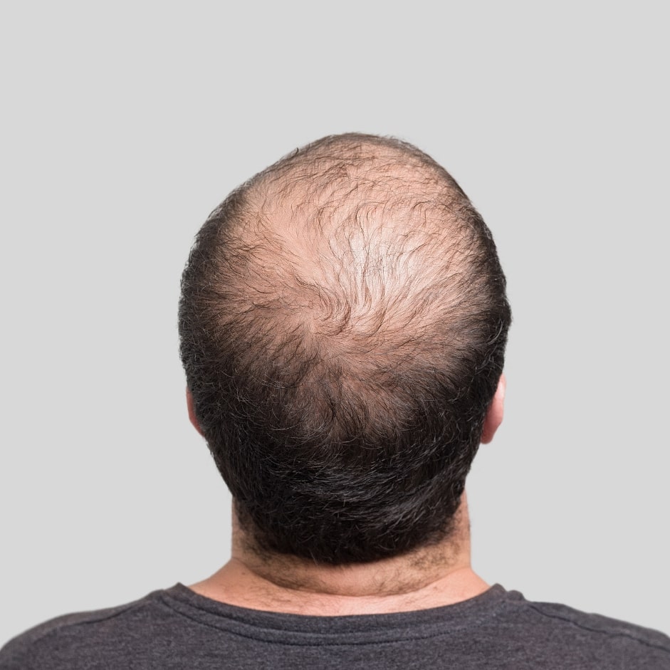 Balding Crown