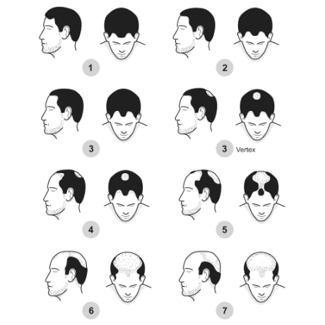Norwood Scale