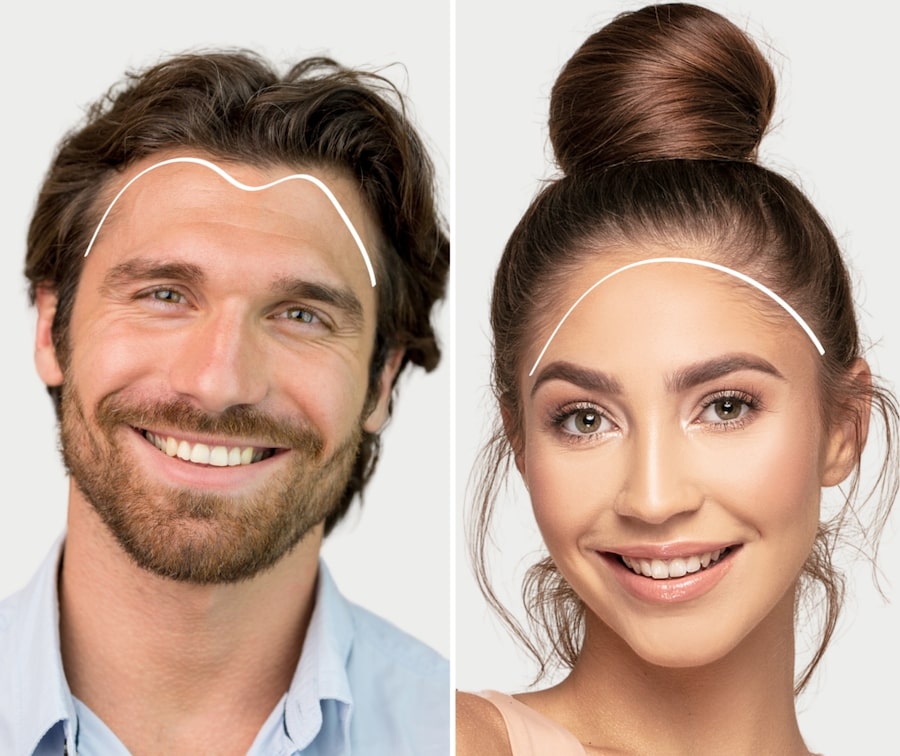 Transgender Hair Transplant