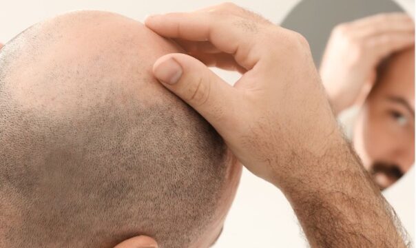 Decoding FUE Hair Transplant Techniques- A Closer Look at DHI and PFP Similarities