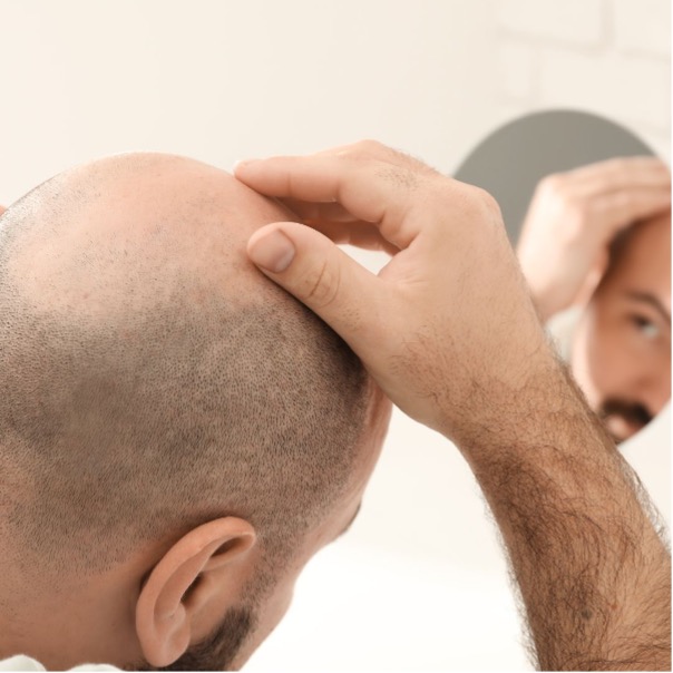 Decoding FUE Hair Transplant Techniques- A Closer Look at DHI and PFP Similarities