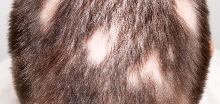 ALopecia