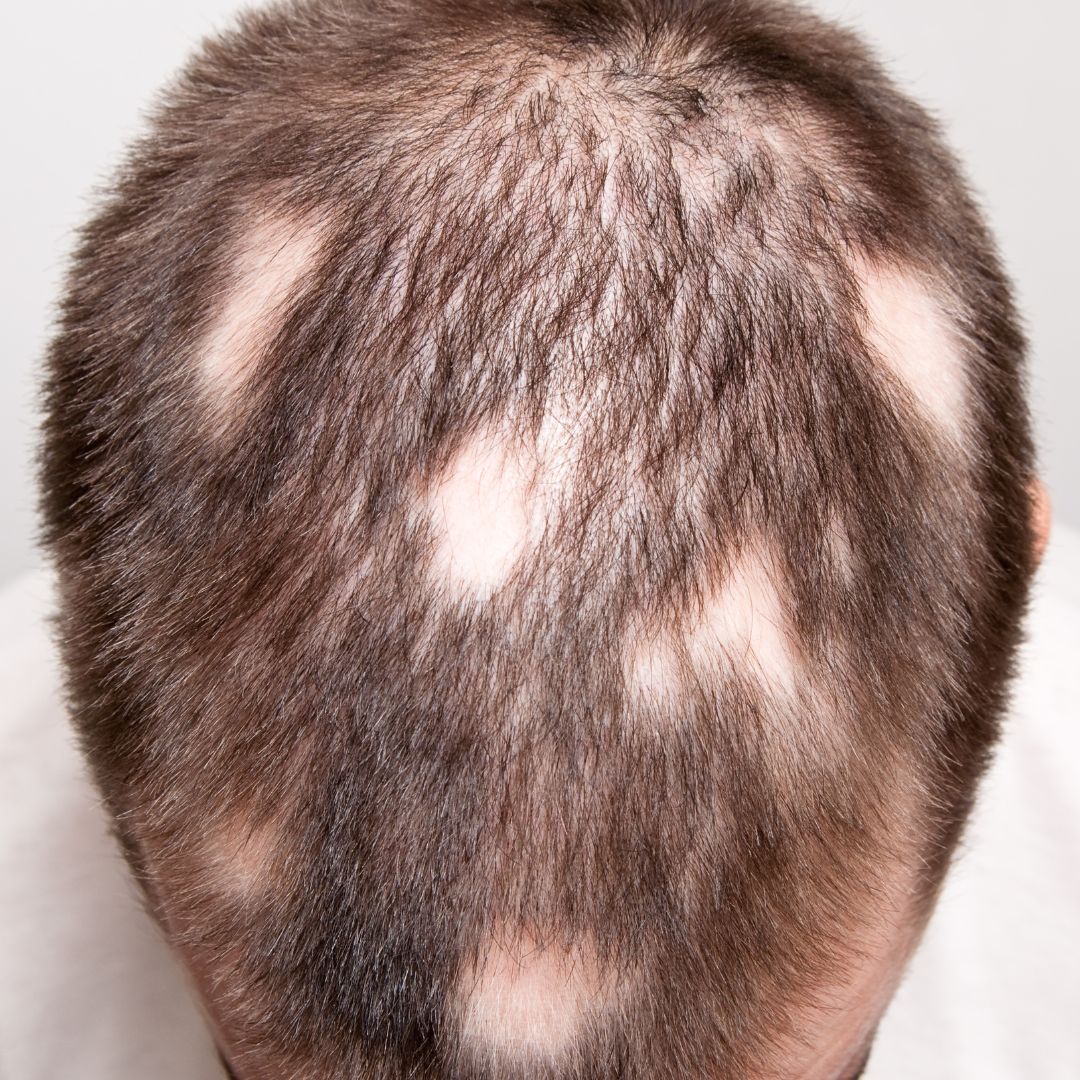 ALopecia