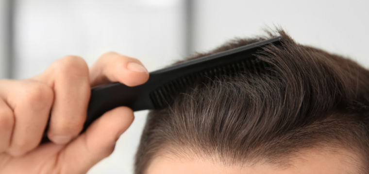 Alopecia