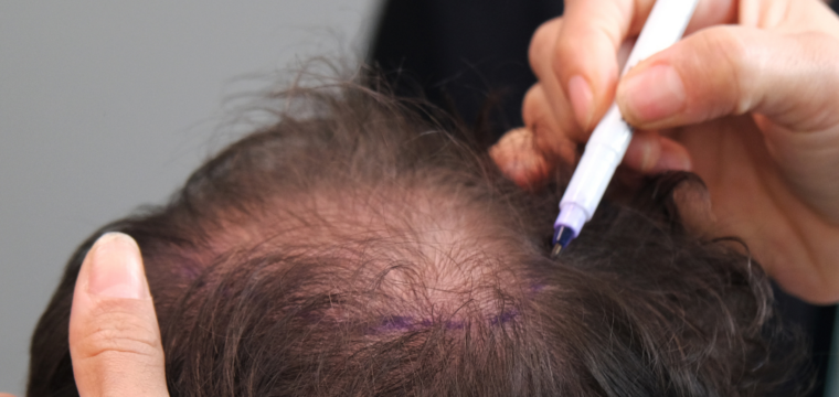 Hair Transplant