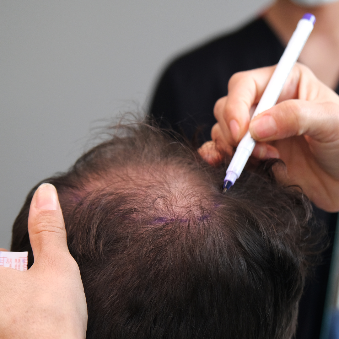 Hair Transplant