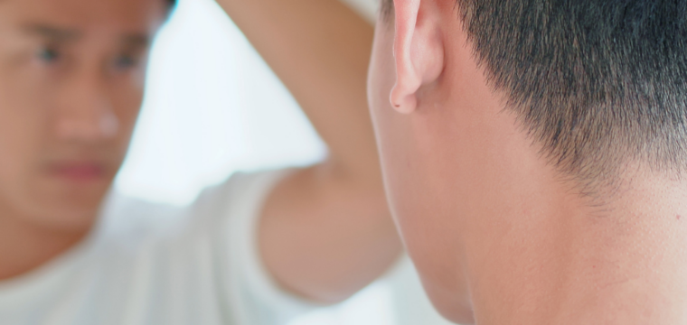Hair Loss