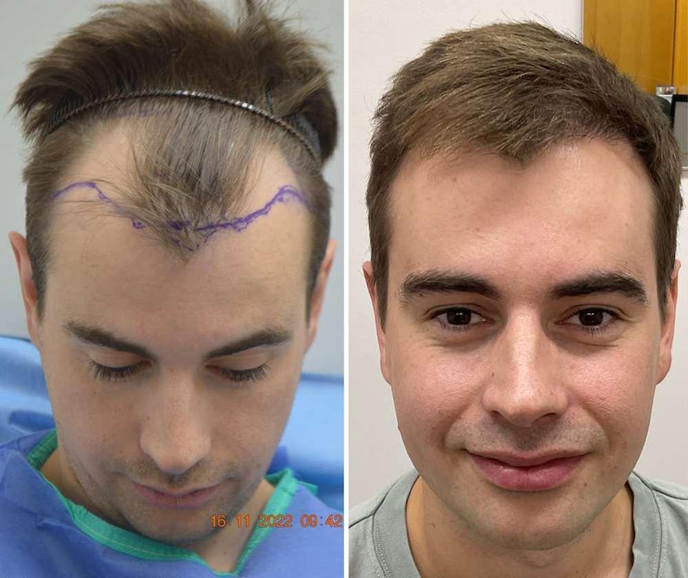 FUE Hair Transplant Perth | Hair Clinic | Hair Transplant Before And After | Hair Loss Treatment