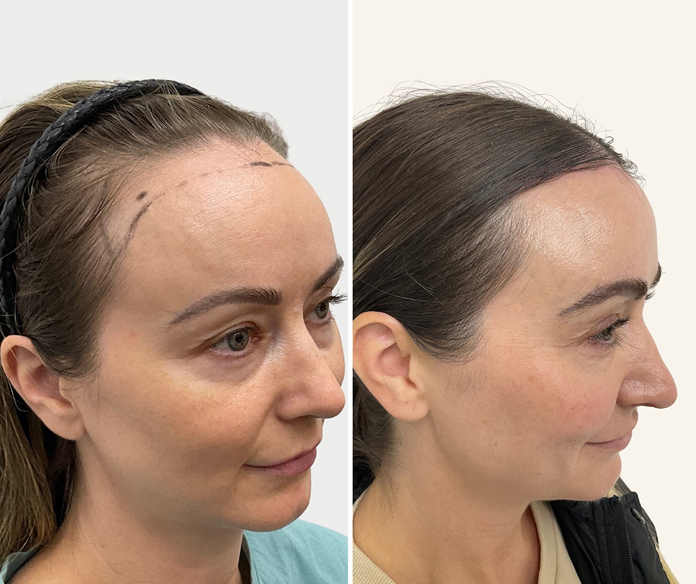 Forehead Reduction Surgery | Hairline Lowering Surgery Perth | Hair Clinic | Before and After | Feminine Face Shape