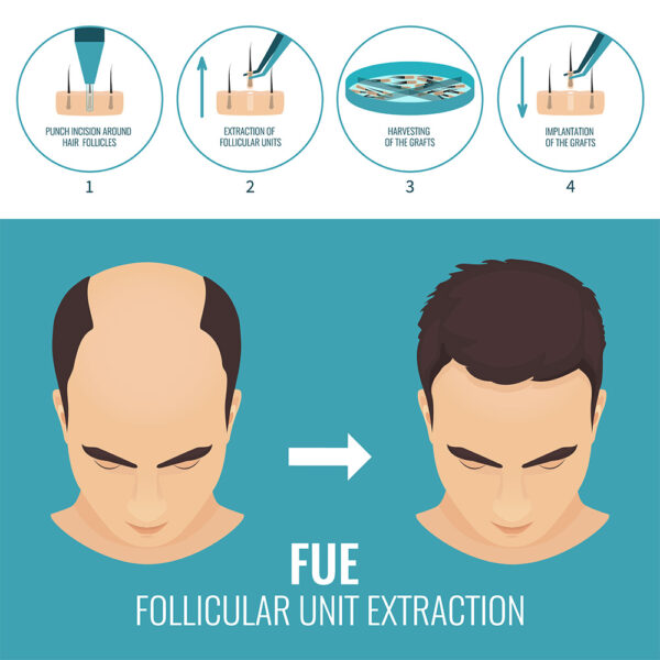 FUE Hair Transplant Perth Hair Restoration Clinic