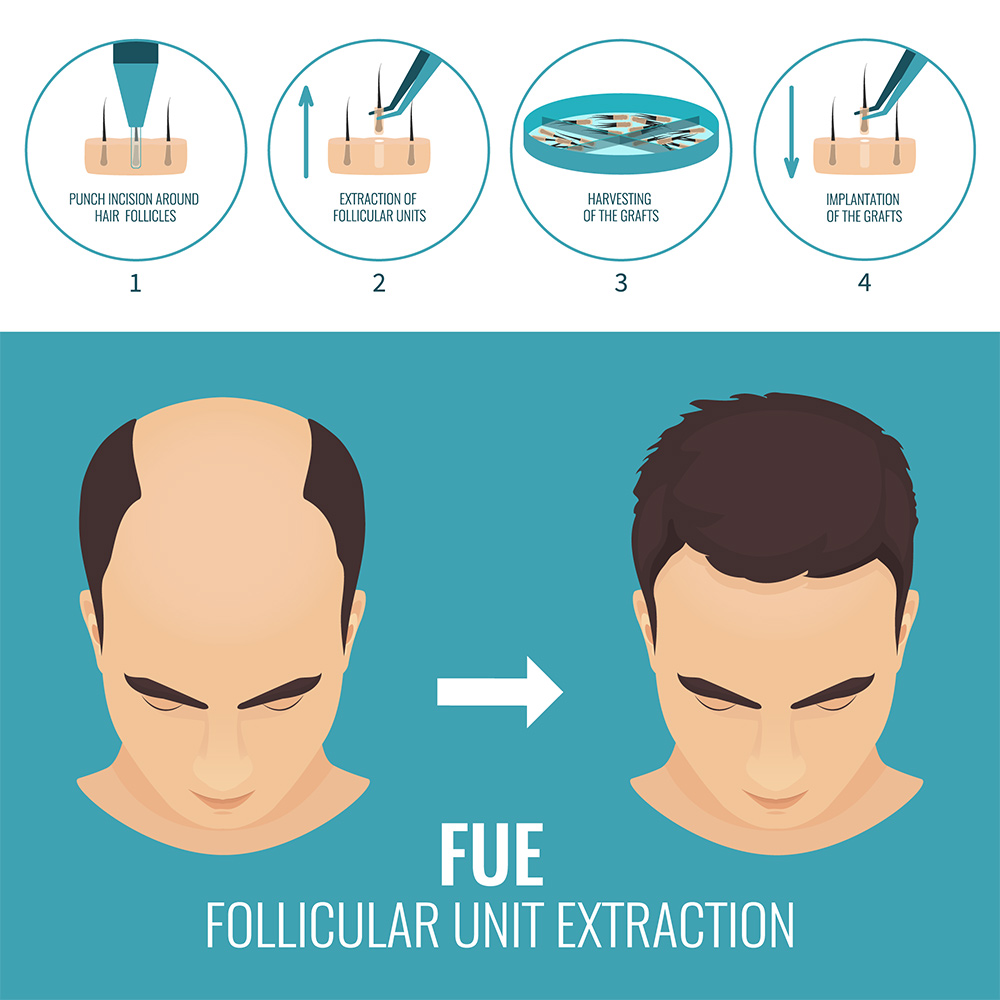 FUE Hair Transplant Perth | Hair Clinic | Hair Transplant Before And After | Hair Loss Treatment