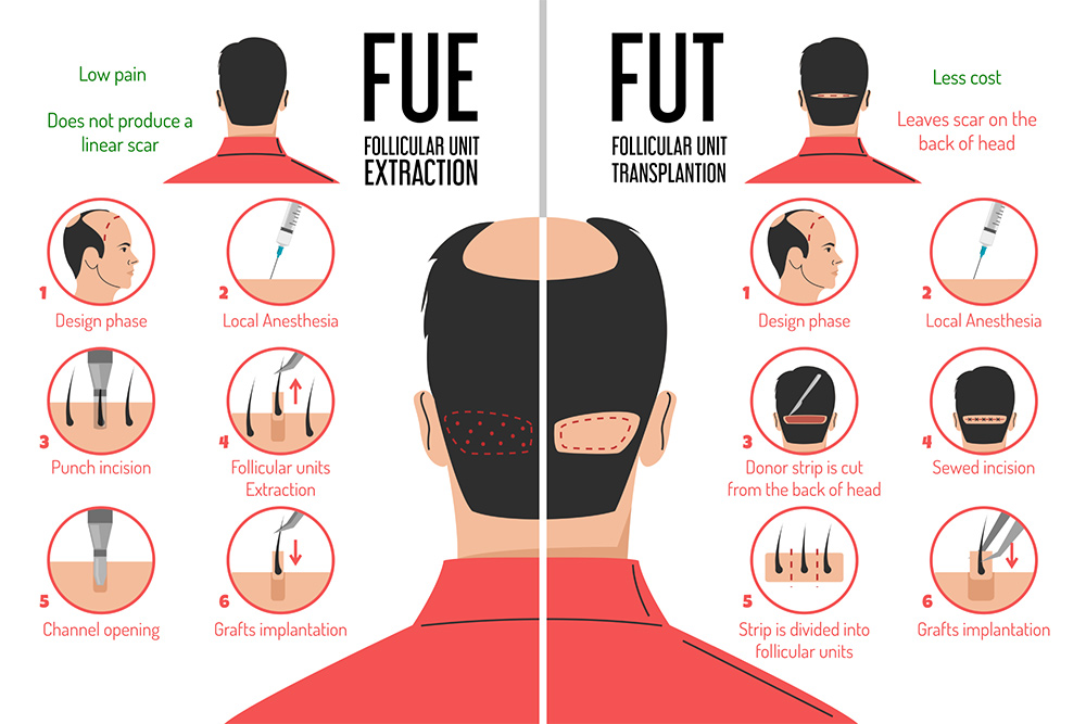 Hair Transplant Perth | FUE Hair Transplant | FUT Hair Transplant | Male Pattern Baldness | Hair Doctors Perth