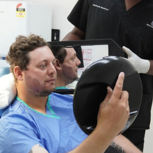 Beard Transplant