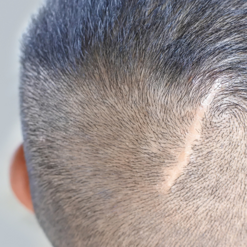 Hair Transplant on Scar