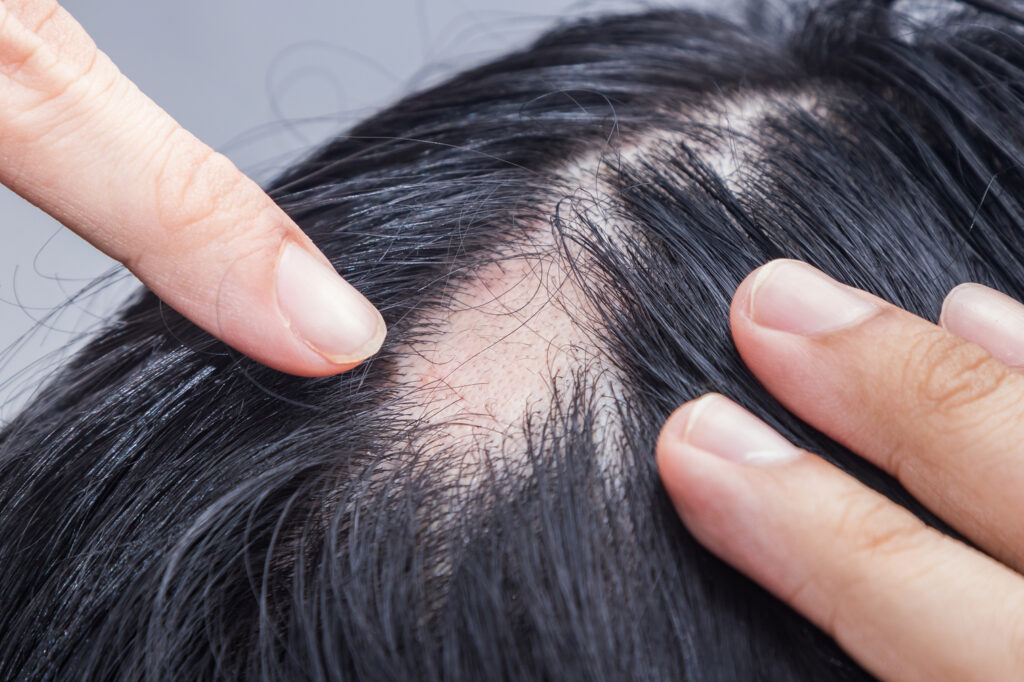 Alopecia Areata Treatment