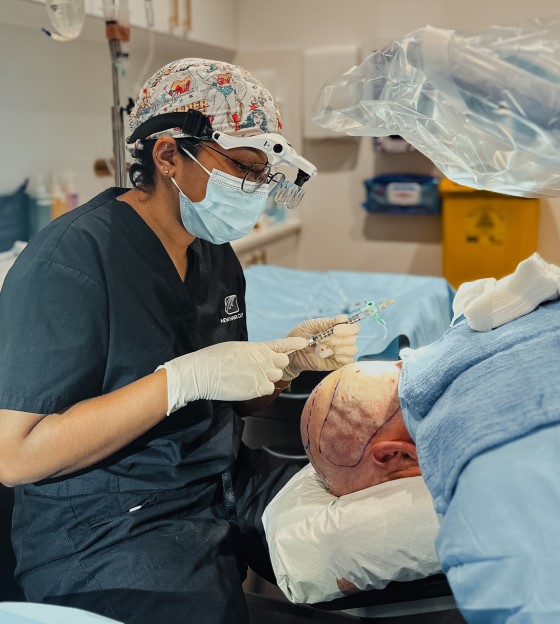 beard transplant