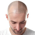Swelling After Hair Transplant | Post Procedure Guide for Hair Transplant Patients | Hair Transplant Healing Process | New Hair Clinic Perth