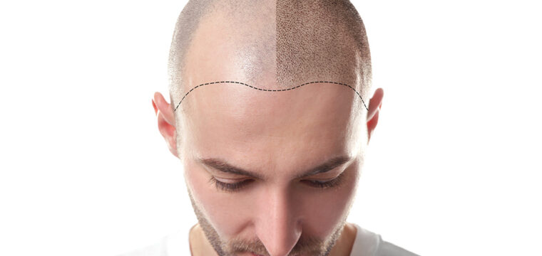 Swelling After Hair Transplant | Post Procedure Guide for Hair Transplant Patients | Hair Transplant Healing Process | New Hair Clinic Perth